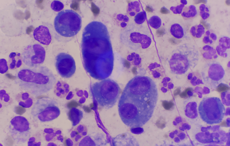 mesothelioma micro pic